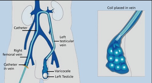 Best Varicocele Embolisation Doctor in Andheri, Mumbai